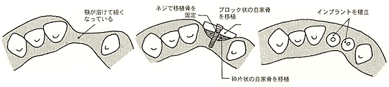 骨移植 特殊手術 大阪市のインプラント歯科医院 アーティスティックデンタルクリニック