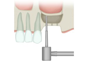 ソケットリフト
